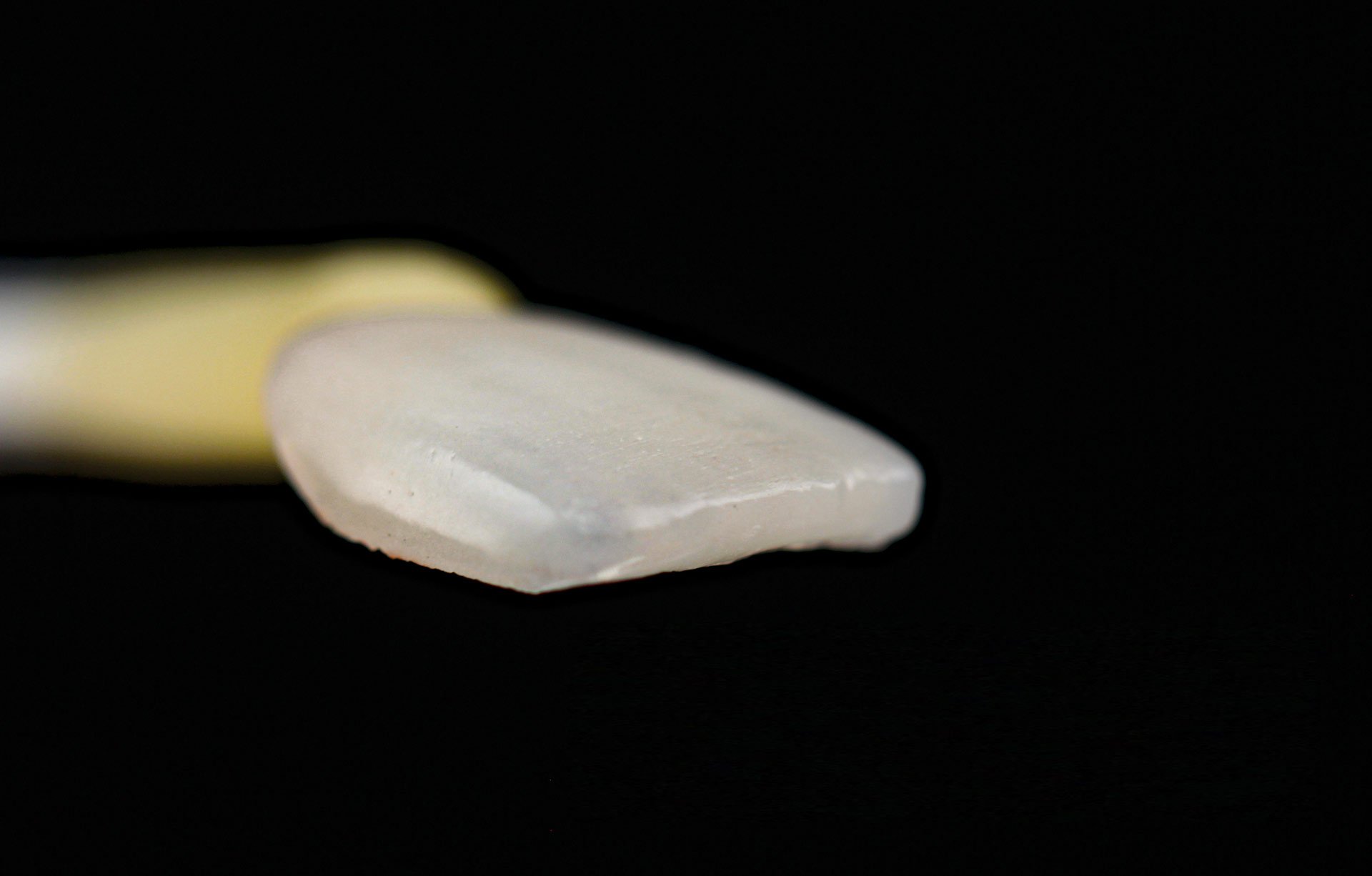 Porcelain Veneer